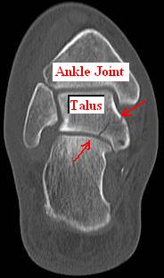 Talus Bone Injury
