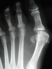Head Procedure Bunion Surgery Seattle