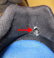 boney prominence / haglund's deformity rubbed a hole in shoe