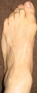 Pain Outside the Foot