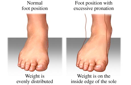 Plantar Fasciitis,Pes Planus,Mallet Toe,High Arched Feet,Heel Spur,Heel Pain,Hammer Toe,Hallux Valgus,Foot Pain,Foot Hard Skin,Foot Conditions,Foot Callous,Flat Feet,Fallen Arches,Diabetic Foot,Contracted Toe,Claw Toe,Bunions Hard Skin,Bunions Callous,Bunion Pain,Ball Of Foot Pain,Back Pain