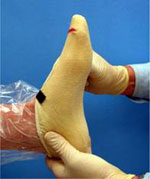 Foot Orthotic Casting Seattle