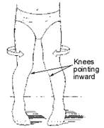 Knees Pointing Inward