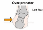 Over-pronator