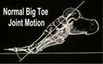 Bunion Treatment Seattle