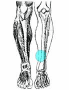 shin splints
