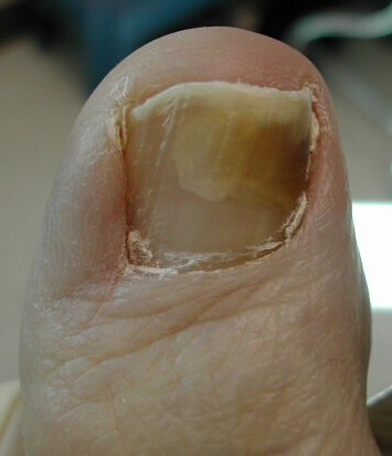 Figure 1 - Potential nail fungus