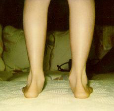 Over Pronation Causes Self Evaluation Treatment
