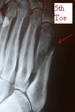 5th metatarsal shaft fracture 5th metatarsal shaft fracture
