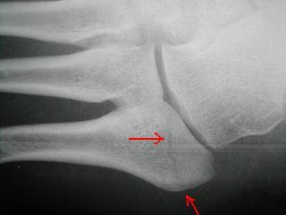 5th metatarsal tuberosity fracture 5th metatarsal tuberosity fracture