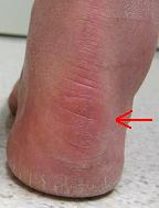 Heel Discomfort