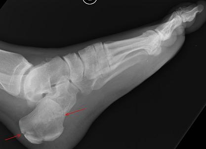 calcaneal fracture calcaneal fracture