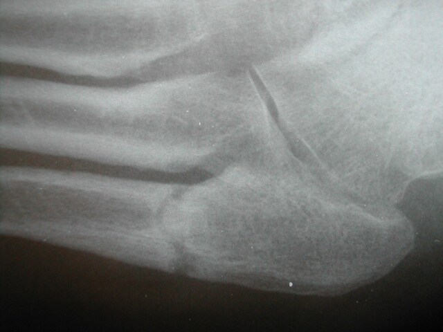 jones fracture jones fracture