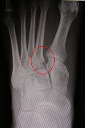 lisfranc fracture lisfranc fracture
