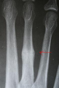 metatarsal stress fracture metatarsal stress fracture