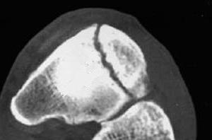 navicular stress fracture navicular stress fracture