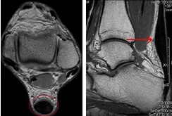 Achilles Tendonitis