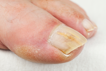 osteomyelitis