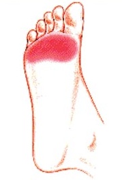 metatarsalgia slippers