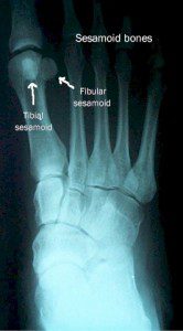 Sesamoiditis