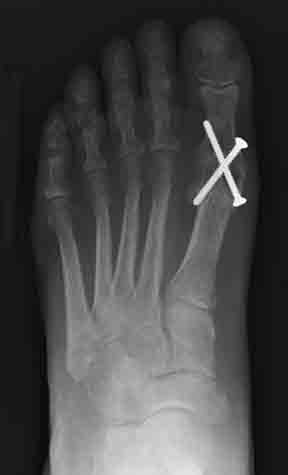 Hallux Rigidus