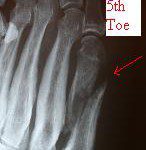 fifth metatarsal shaft fracture