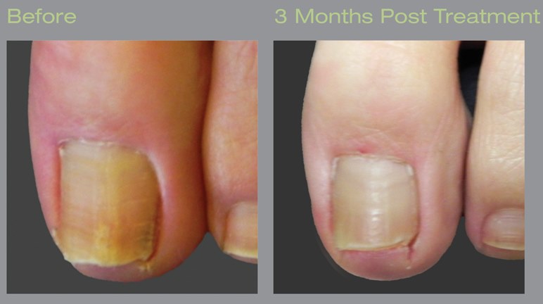 Nail Fungus Treatment - Podiatrists in Richmond VA