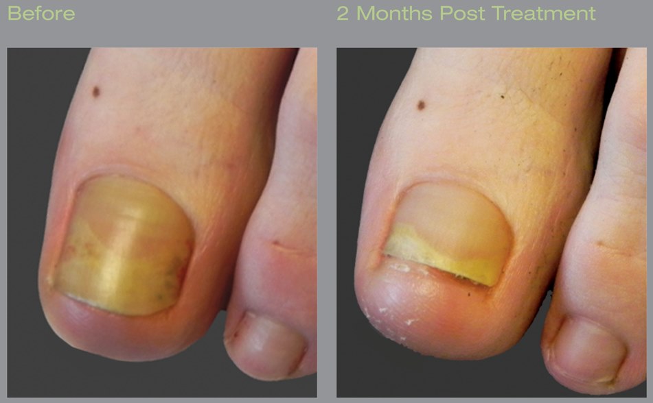 laser for ugly toenails