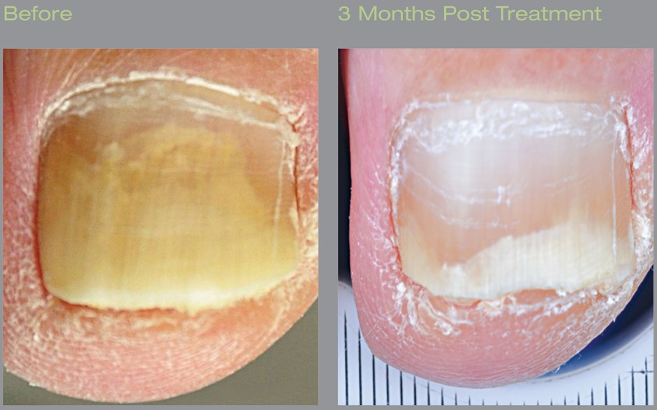 Laser Treatment for Toenail Fungus Onychomycosis