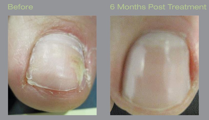 laser toenail surgery