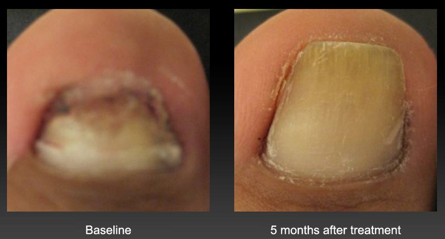 Onychomycosis Treatment - Toenail Fungus Specialist VA