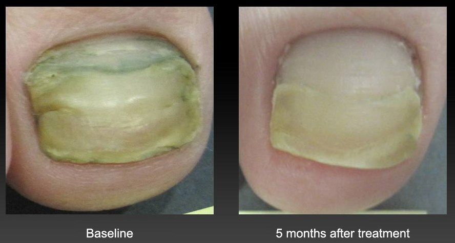 Types of Toenail Fungus: Pictures, Symptoms, Treatment