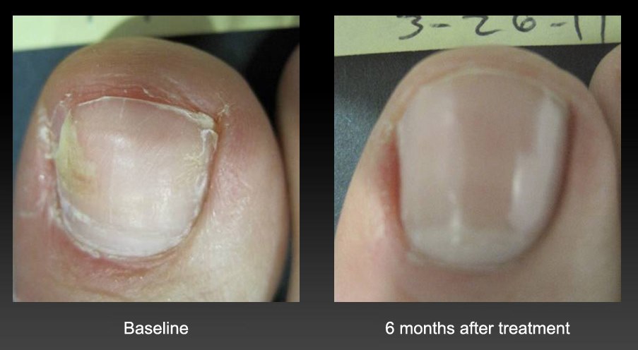 Seattle toenail fungus treatment 