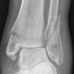 broken ankle fracture
