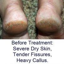 split heel callus