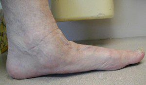 flat-foot-posterior-tibial-dysfunction