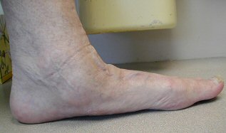 flat foot posterior tibial dysfunction