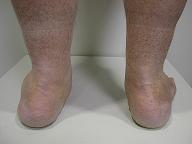 flat foot posterior tibial tendon dysfunction