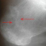 foot heel fracture