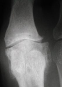 hallux rigidus