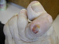 hammertoe causing ulcertion