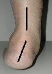 heel posterior tibial dysfunction
