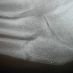 jones fracture