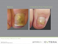 toenail fungus in children