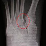 lisfranc fracture