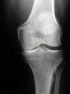 medial-osteoarthritis