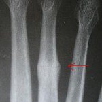 metatarsal stress fracture