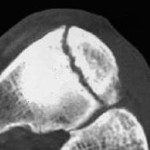 navicular stress fracture