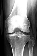 orthotics-for-knee-arthritis