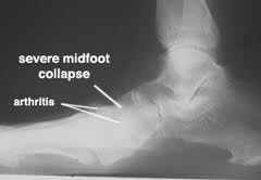 xray mid foot arthritis